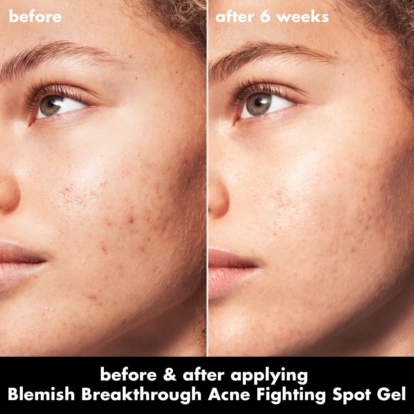 blemish-breakthrough-acne-fighting-spot-gel-z4 0326_EDU_BB_SpotGel_BA_MARLEY.jpg