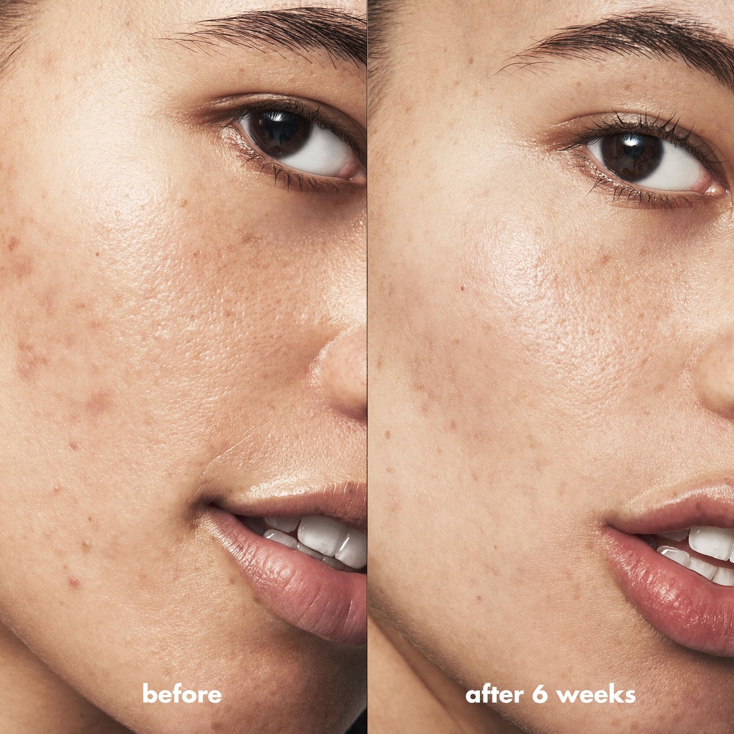 blemish-breakthrough-blemish-control-basics-kit-x5 Acne_PDP_Isabella_Before_After_0fcb9356-ae60-4e94-8953-6b1b2219dc49.jpg
