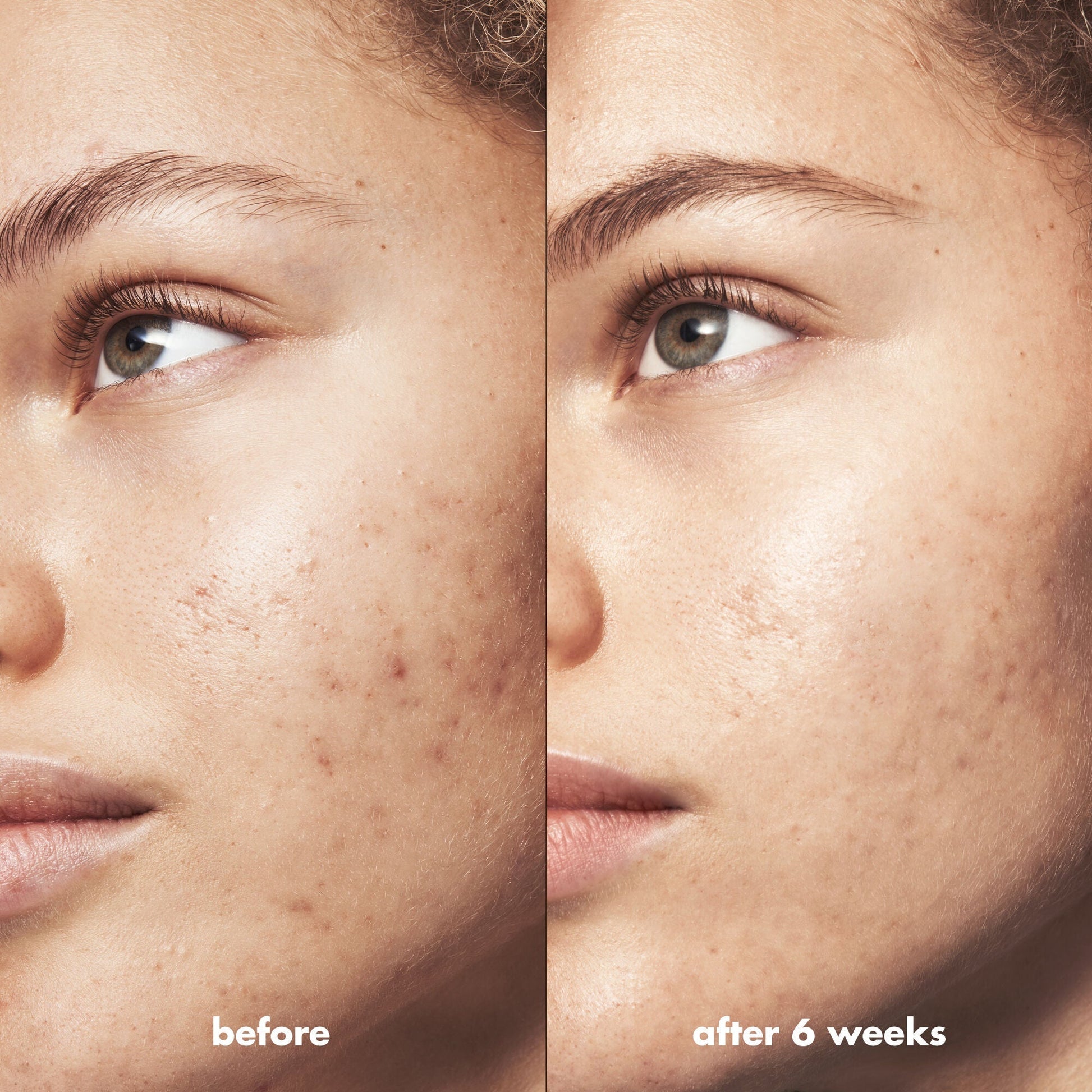blemish-breakthrough-triple-acid-resurfacing-serum-j6 Acne_PDP_Marley_Before_After_1a95cac5-0af6-43b6-a936-d0bacbdec0bf.jpg